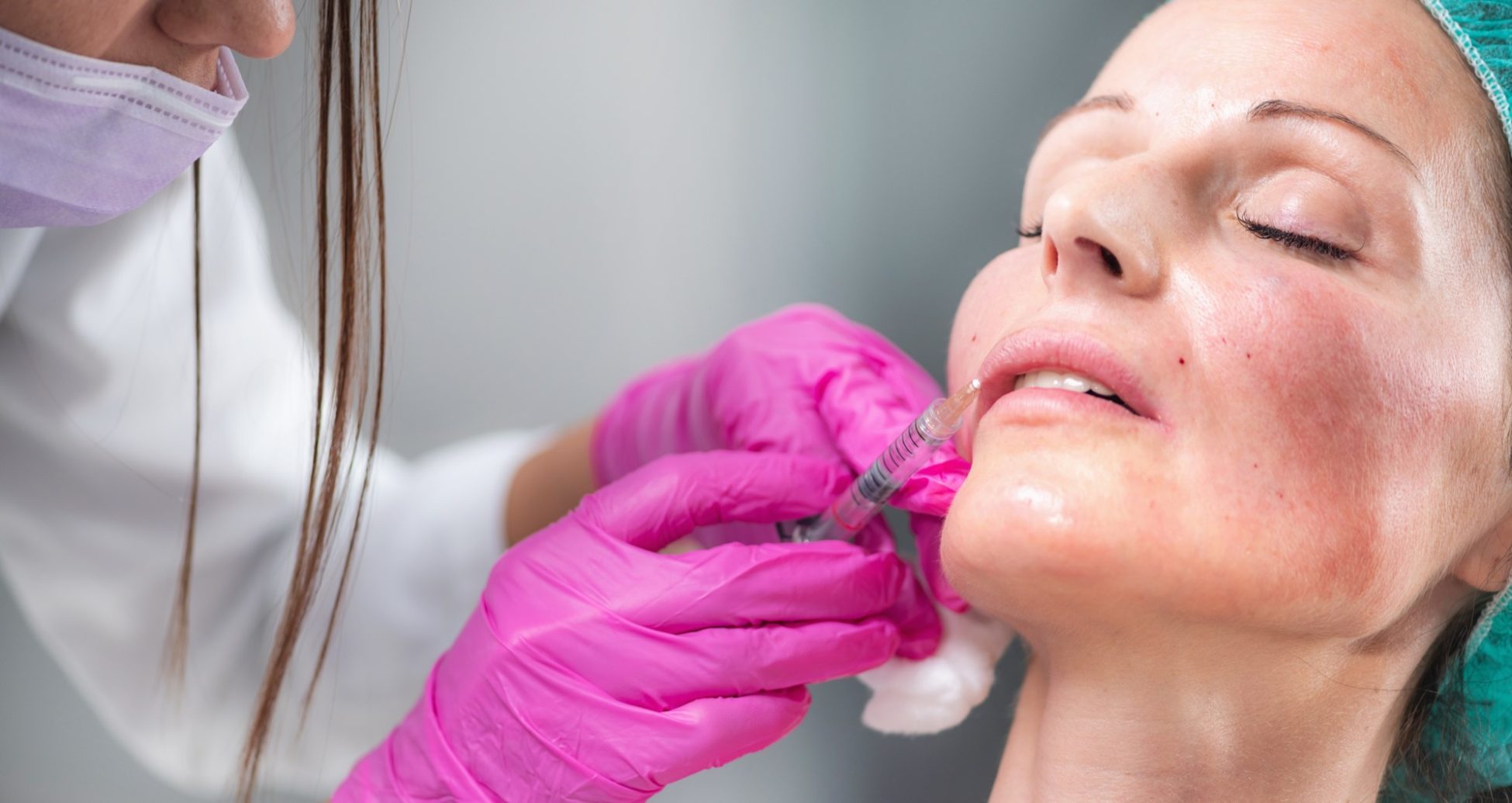 woman-geting-dermal-filler-injection-in-her-face-at-vishca-skincare-863AVCT Dermal FillerTreatment at Vishka Skincare
