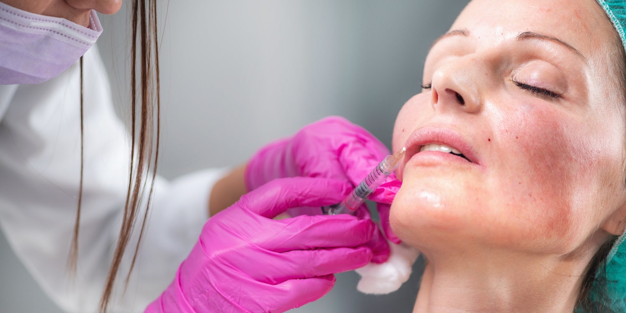 woman-geting-dermal-filler-injection-in-her-face-at-vishca-skincare-863AVCT Dermal FillerTreatment at Vishka Skincare