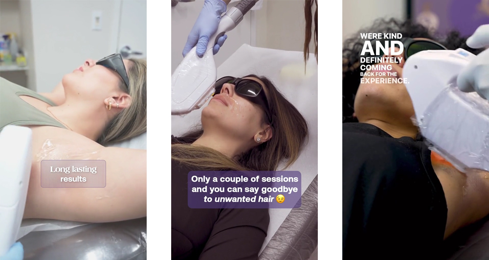 Three different laser hair removal sessions with three women