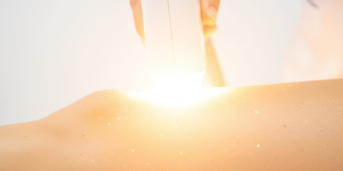 Laser Hair Removal for Sensitive Skin – Full Guide Laser Hair Removal for Sensitive Skin – Full Guide