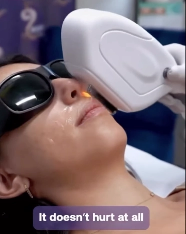 laser hair removal